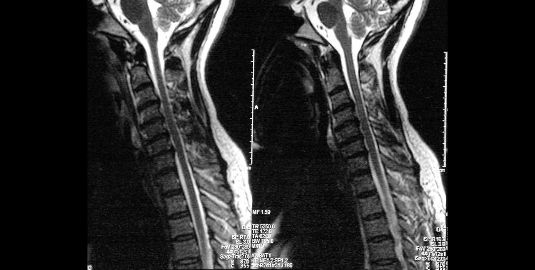 Cervical Stenosis Mri Img Abhilasha